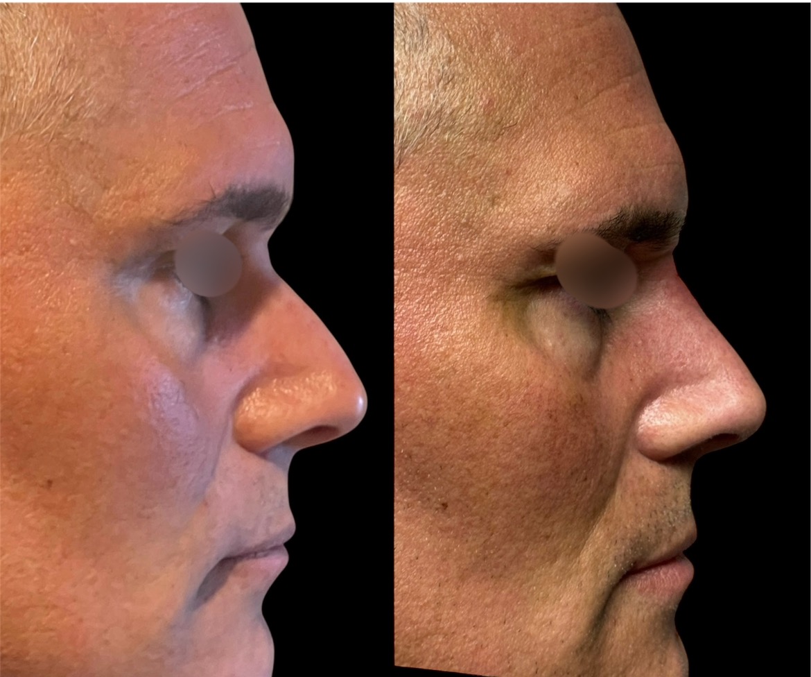 Before and After - Liquid Rhinoplasty